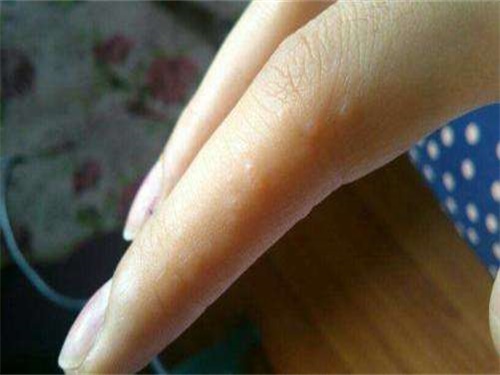 水痘痒?€么办