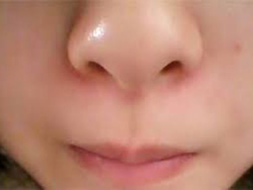 鼻子两侧发红是什么原因
