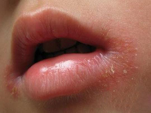 嘴角烂了留疤怎么办