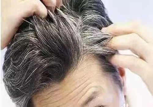 俩鬓长白发是什??原因